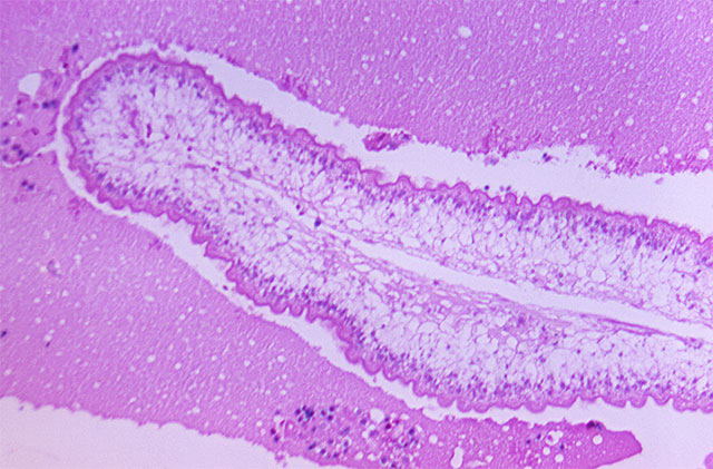 cysticercosis_002