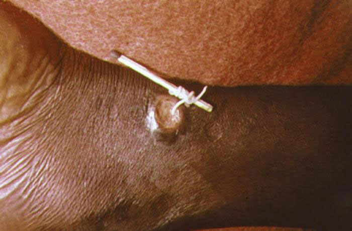 dracunculiasis_002