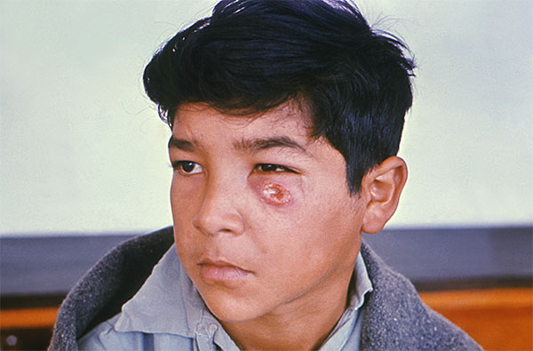 leishmaniasis_002