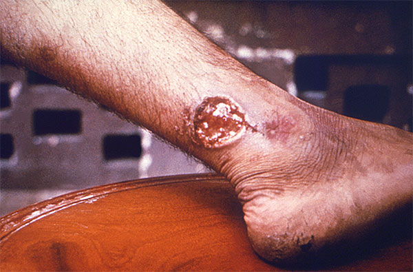 leishmaniasis_003