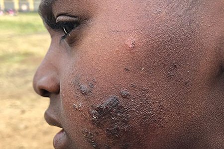 leishmaniasis_004