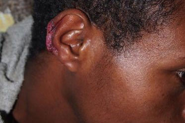 leishmaniasis_006