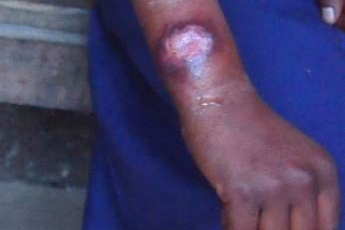 leishmaniasis_008