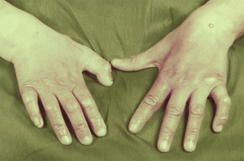 leprosy_001
