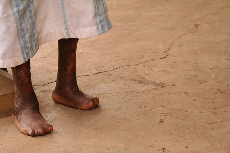 leprosy_002