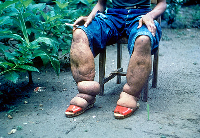 lymphaticfilariasis_001
