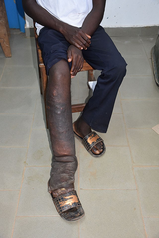 lymphaticfilariasis_002