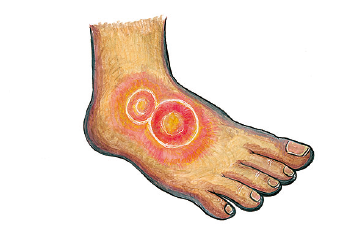 Buruli ulcer