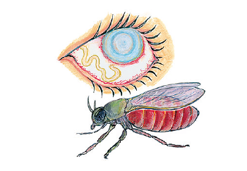 Onchocerciasis