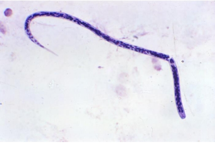 onchocerciasis_001