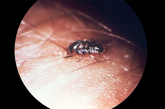 onchocerciasis_003