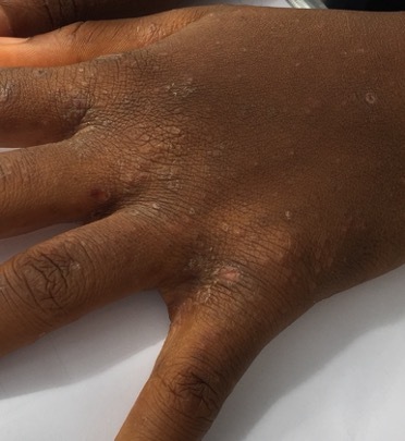 scabies_002