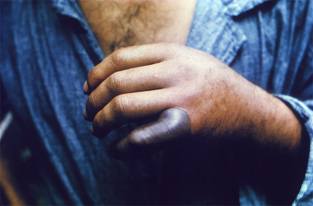 snakebite_001